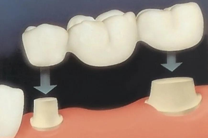 Porselen Diş Köprüleri