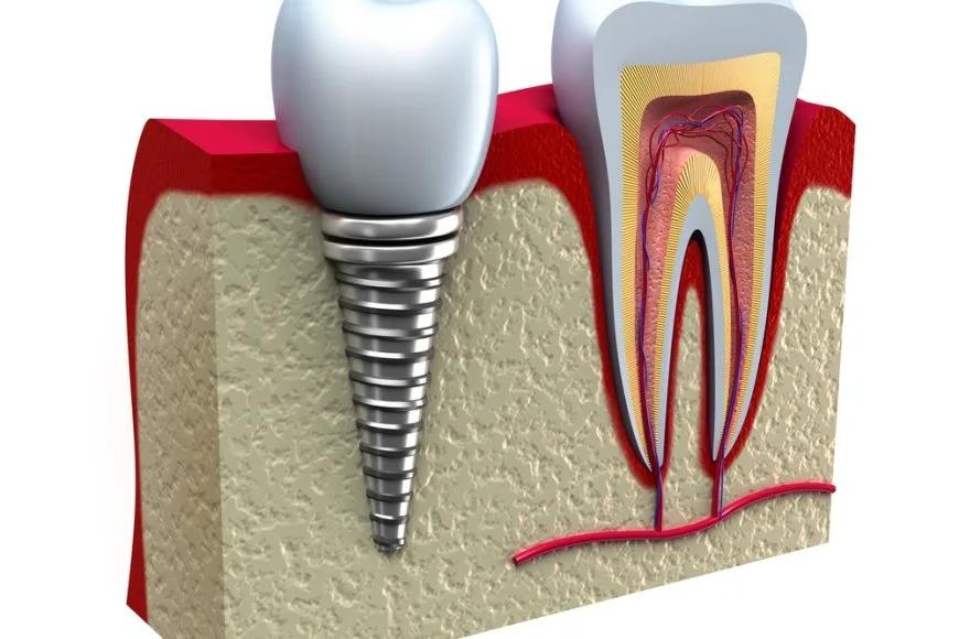 Diş Hekimlerine Ücretsiz "Periodontoloji ve Oral İmplantoloji" Eğitimi